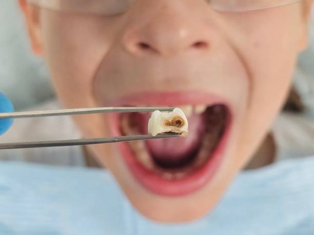 Best Root Canal Emergency Dentist  in Winterset, IA
